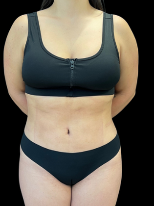 Liposuction Case 1 - After