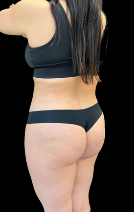 Liposuction: Case 1 - After