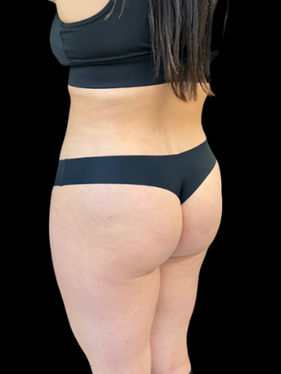 Liposuction: Liposuction 4 - After