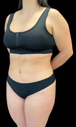 Liposuction: Case 1 - After