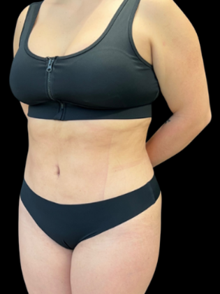 Liposuction: Liposuction 4 - After