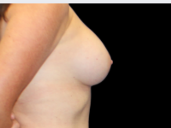 Breast Augmentation: Case 2 - After