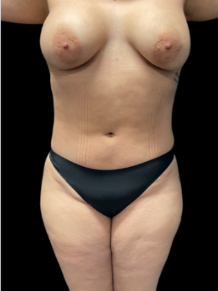 Liposuction: Case 2 - Before