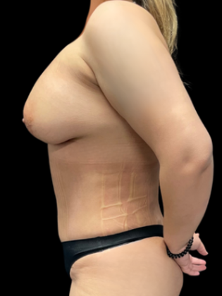 Liposuction Case 2 - After