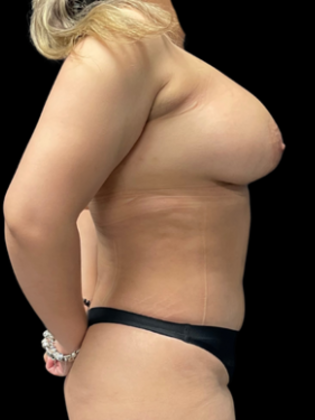 Liposuction: Case 2 - After