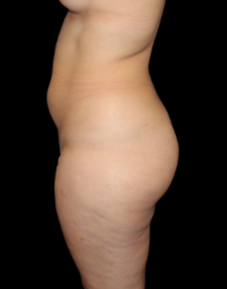 Brazilian Butt Lift: Case 2 - Before