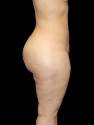 Brazilian Butt Lift Case 2 - After