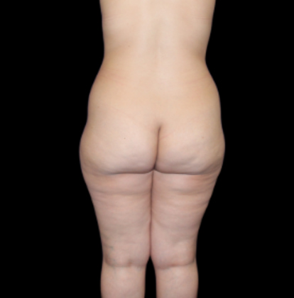 Brazilian Butt Lift: Case 2 - Before