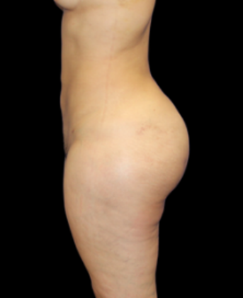 Brazilian Butt Lift: Case 2 - After