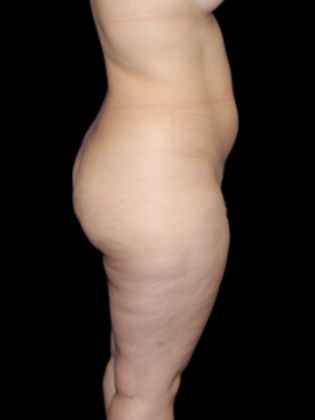 Brazilian Butt Lift Case 2 - Before