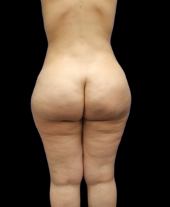 Brazilian Butt Lift: Case 2 - After