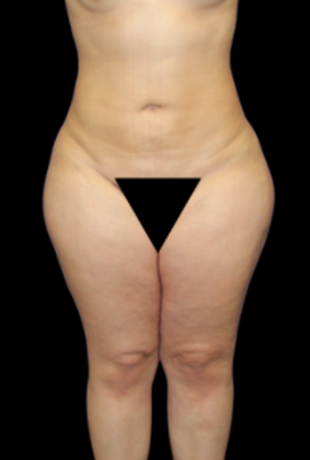 Brazilian Butt Lift: Case 2 - After