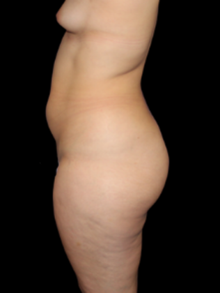Liposuction Case 3 - Before