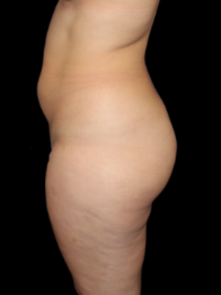 Liposuction: Liposuction  12 - Before