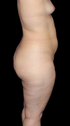 Liposuction: Case 3 - Before