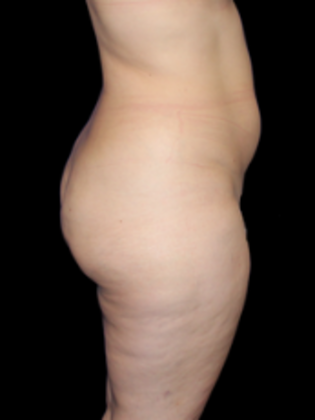 Liposuction: Liposuction  12 - Before