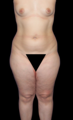 Liposuction: Case 3 - Before