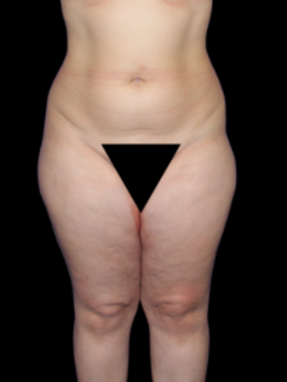 Liposuction Liposuction  12 - Before