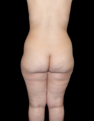 Liposuction: Case 3 - Before