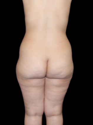 Liposuction: Liposuction  12 - Before