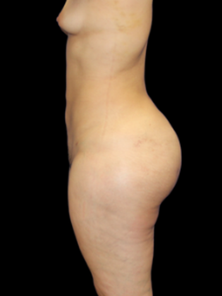 Liposuction Case 3 - After