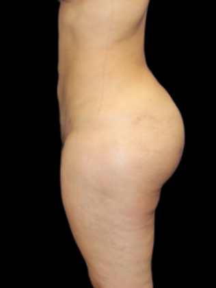 Liposuction: Liposuction  12 - After