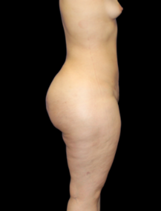 Liposuction: Case 3 - After