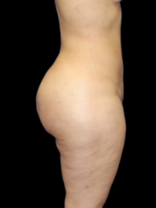 Liposuction: Liposuction  12 - After
