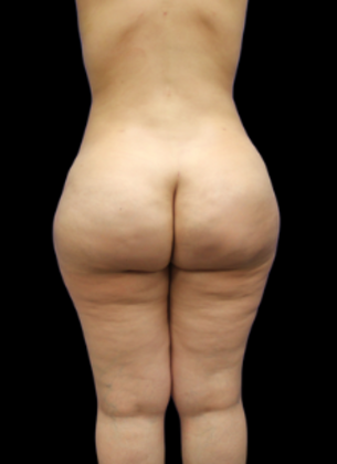 Liposuction: Case 3 - After