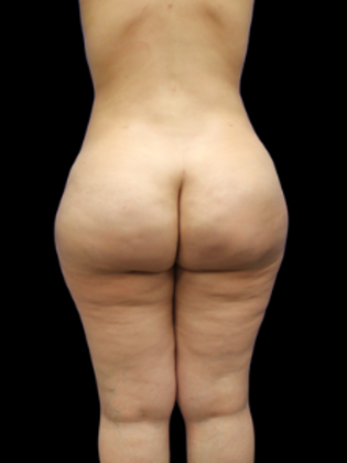 Liposuction: Liposuction  12 - After