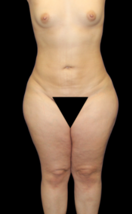 Liposuction: Case 3 - After