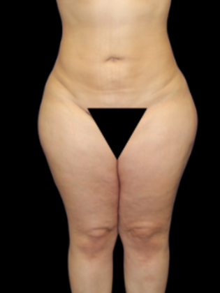 Liposuction Liposuction  12 - After