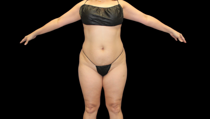 Brazilian Butt Lift: Case 3 - Before