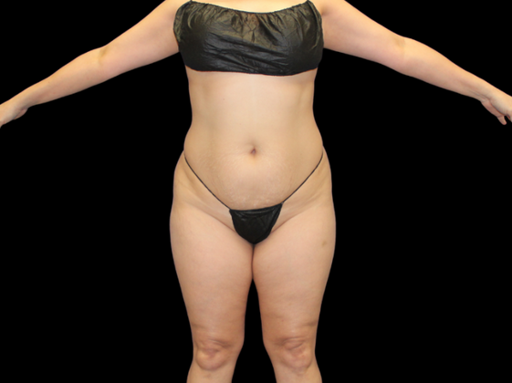 Brazilian Butt Lift: BBL 12 - Before