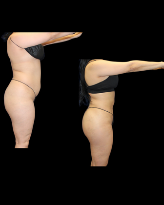 Brazilian Butt Lift: Case 3 - Before