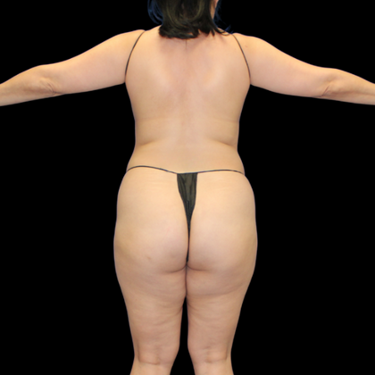 Brazilian Butt Lift Case 3 - Before