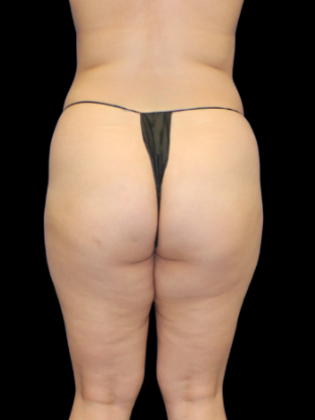 Brazilian Butt Lift BBL 12 - Before