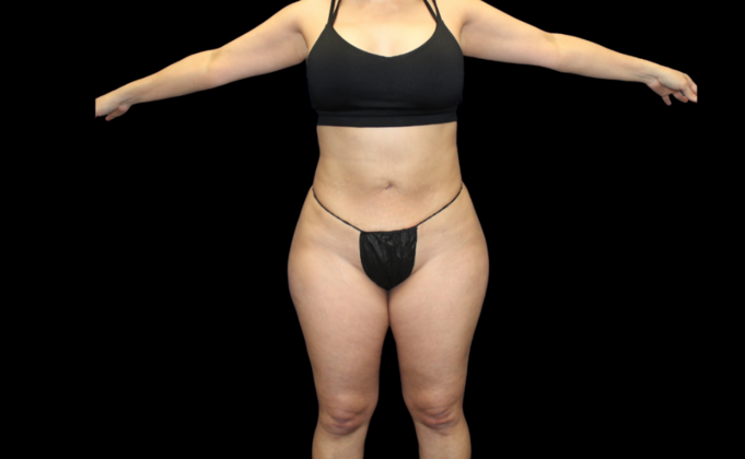 Brazilian Butt Lift: Case 3 - After