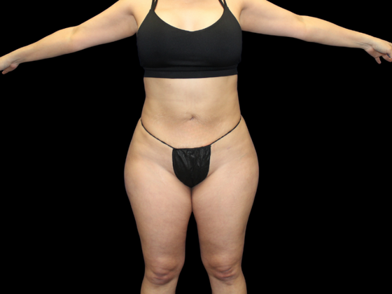 Brazilian Butt Lift: BBL 12 - After