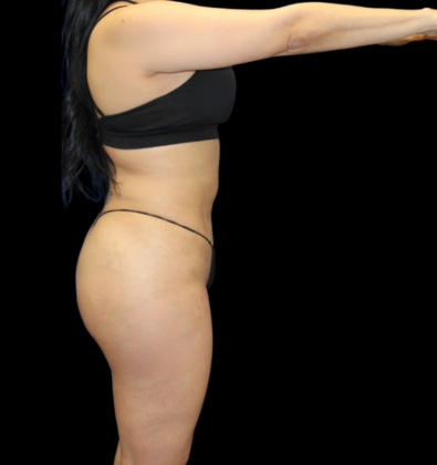 Brazilian Butt Lift: Case 3 - After