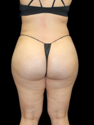 Brazilian Butt Lift BBL 12 - After