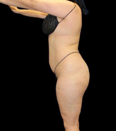 Brazilian Butt Lift: Case 3 - After