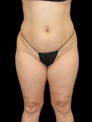 Liposuction Liposuction 10 - Before