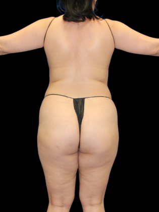 Liposuction: Liposuction 10 - Before