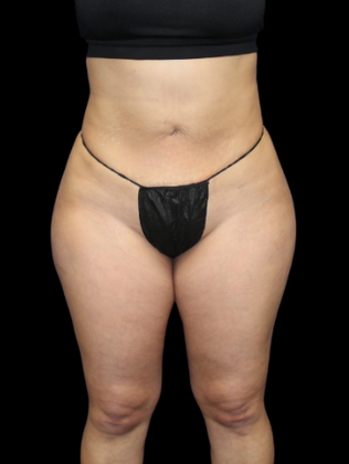 Liposuction Liposuction 10 - After