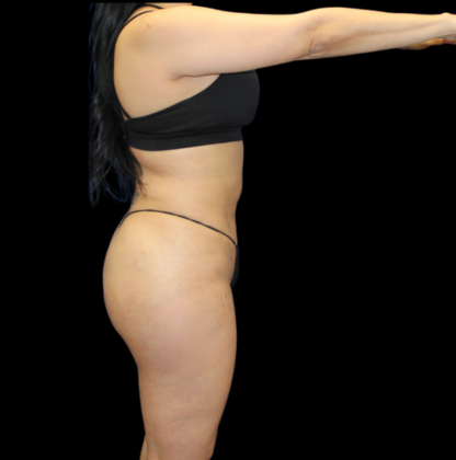 Liposuction: Case 4 - After