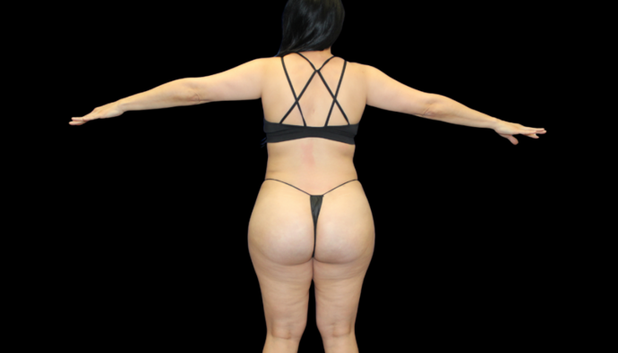 Liposuction: Case 4 - After