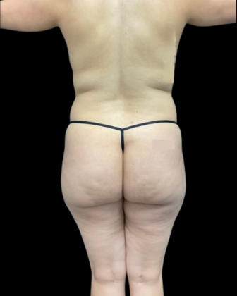 Tummy Tuck: Case 1 - Before