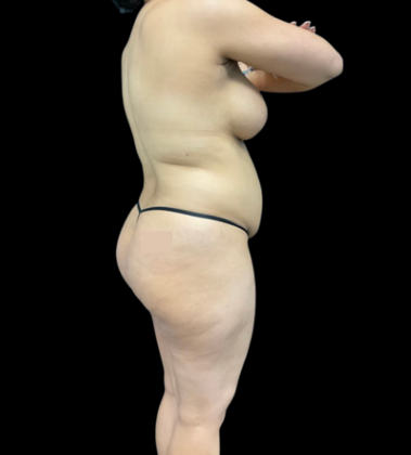 Tummy Tuck: Case 1 - Before