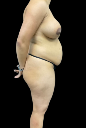 Tummy Tuck: Case 1 - Before